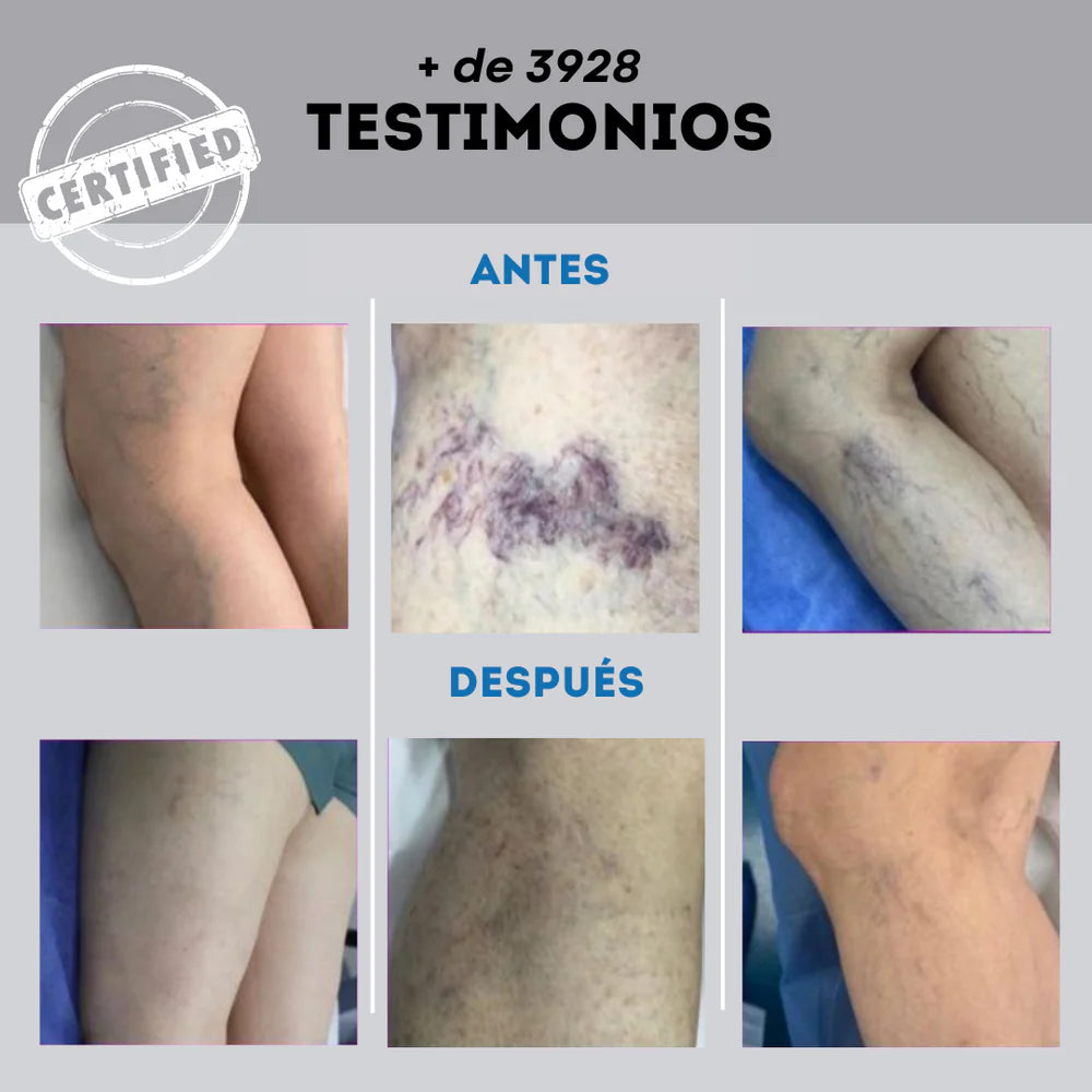 🌿Varicose Veins ✅¡Clínicamente probado para eliminar las venas varicosas